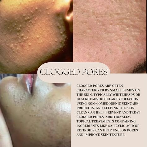 This is an informative post for everyone! A lot of clients text me with “ I have Cystic acne ” but when they come for consultation it’s only clogged pores or damage skin barrier! If you cannot identified your skin concern or issue always consult with a professional 🌸 #facialstoronto #skincare #skinexpert #lymphaticdrainage #selfcare #hairremoval #smallbusiness Body Therapy, Cystic Acne, Clogged Pores, Skin Barrier, Skin Concern, Text Me, Damaged Skin, Hair Removal, For Everyone