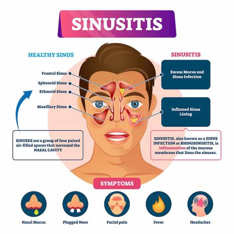 Sinus Headache Remedies, Remedy For Sinus Congestion, Sinus Inflammation, Sinus Drainage, Home Remedies For Sinus, Maxillary Sinus, Sinus Congestion Relief, Chronic Sinusitis, Sinus Pain