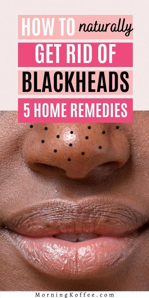 How to clear off blackheads quickly? Here is a post on how you can get rid off blackheads naturally and quickly that are worth to try. #NaturalHomeRemediesForCough #ColdSoreRemedies Blind Pimple, Pimples Under The Skin, Acne Overnight, Pimples Remedies, Rid Of Blackheads, Home Remedy For Cough, Cold Sores Remedies, How To Get Rid Of Pimples, Natural Health Care