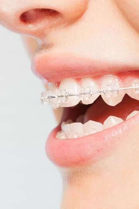 Lingual Braces, Flossing Teeth, Dental Wallpaper, Ceramic Braces, Types Of Braces, Braces Tips, Dental Photography, Clear Braces, Braces Colors