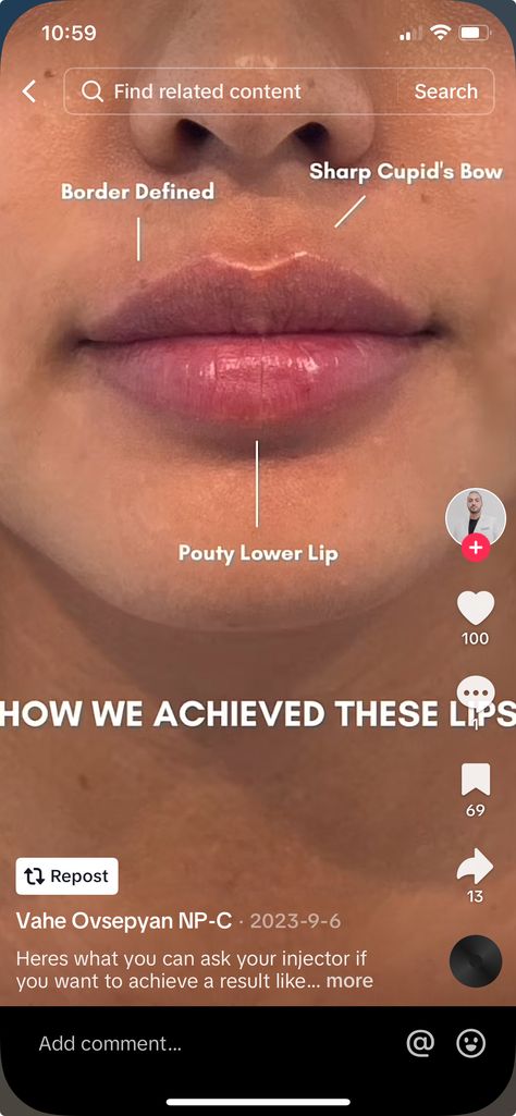 Asian Lip Filler, Heart Shaped Lip Filler, Korean Lip Filler, Lip Filler Technique, Lip Filler Inspiration, Heart Shaped Lips, Lips Inspiration, Korean Lips, Lower Lip