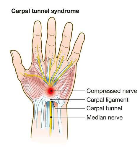 Physical Solutions | Carpal Tunnel Syndrome - Physical Solutions Carpal Tunnel Exercises, Carpal Tunnel Surgery, Median Nerve, Hip Pain Relief, Nursing School Survival, School Survival, Carpal Tunnel, Study Tools, Body Anatomy