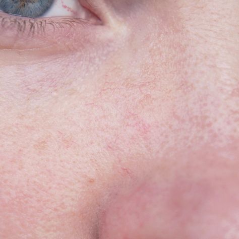 Close up of rosacea thread veins Thread Veins, The Face, Close Up, Thread, Skin