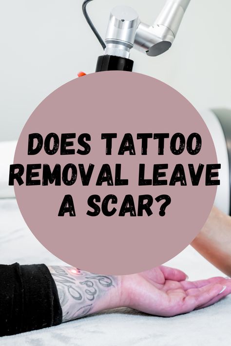 Does Tattoo Removal Leave a Scar? - tattooglee Tattoo Removal Before And After, Tattoo Knowledge, Wanderlust Tattoos, Tattoo Removal Cream, Tattoo Removal Cost, Tattoo Tips, Tattoo Cream, Saved Tattoo, Scar Tattoo