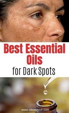 Best Essential oils for dark spots Skin Pigmentation Remedies, Sun Damage On Face, Sun Spots On Face, Age Spots Essential Oils, Pigmentation On Face, Pigmentation Remedy, Sun Spots On Skin, Brown Age Spots, Essential Oils For Face