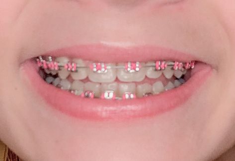 Black Braces Teeth, Perfect Teeth Braces, Pink Braces, Dental Braces Colors, Black Braces, Cute Braces Colors, Getting Braces, Dental Implants Cost, Korean Hair Color