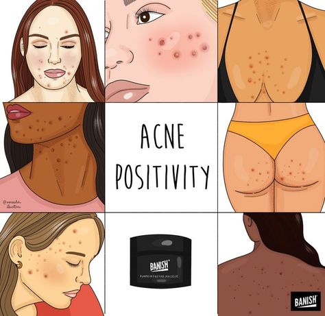 Acne can occur at any age, appear in men and women, last for years, or come and go. Acne can occur in all skin types, and appear in different places. Acne is common, and it's okay! You're still beautiful as is. As we've always said, it's not the way you look, but the way you feel that matters. Illustration by @marcelailustra #skinpositivity #acneawarenessmonth #acnescars #acneprone #acneskin #acnepositivity #banish #banishacnestigma Acne Positivity, Pele Natural, Natural Acne Remedies, Types Of Acne, Body Acne, Lip Hair, Acne Remedies, Cruelty Free Skin Care, Pretty Skin