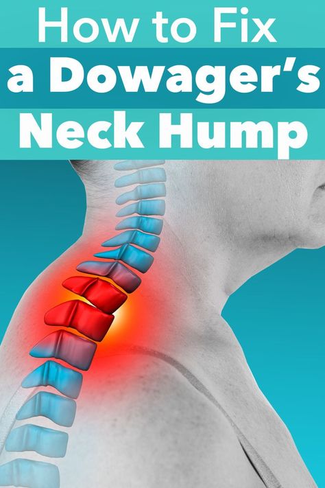 How To Reduce Back Neck Hump Women, Humpback Exercise, Dowagers Hump Correction, Neck Hump Exercises For Women, Dowagers Neck Exercises, Hump Back Neck Exercise, Dowagers Hump Correction Exercises, Neck Exercises For Women, Buffalo Neck