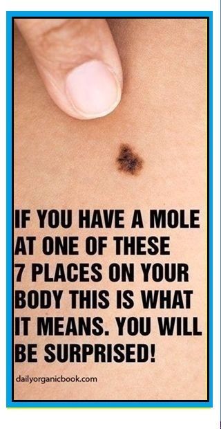 IF YOU HAVE A MOLE AT ONE OF THESE 7 PLACES ON YOUR BODY THIS IS WHAT IT MEANS. YOU WILL BE SURPRISED Mole Meaning, Natural Treatments, Natural Medicine, Health Awareness, Herbal Medicine, Mole, Natural Health, Health Benefits, Natural Remedies