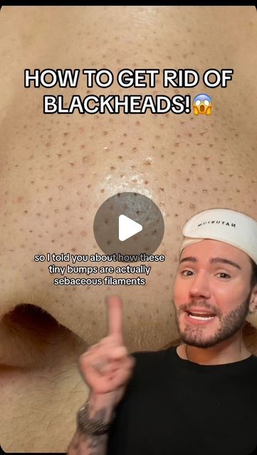 Black Head Remedies, Easy Ways To Get Rid Of Blackheads, Skincare Routine For Blackheads, Best Way To Get Rid Of Blackheads, How To Get Rid Of Pimples And Blackheads, Home Remedies For Blackheads, How To Get Ride Of Black Heads On Nose, How To Extract Blackheads, How To Clear Blackheads On Nose