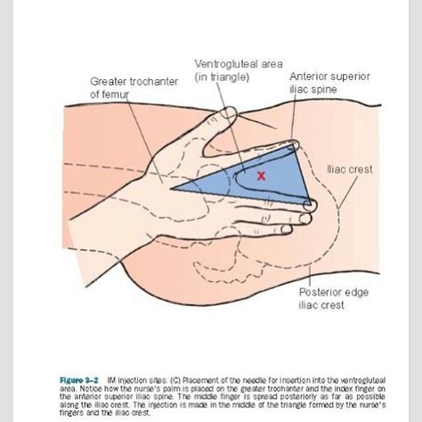 IM VG Ventrogluteal Injection, Injection Sites, Im Injection, Nursing Information, Nursing Fun, Psych Nurse, College Nursing, Nursing Life, Nursing Student Tips