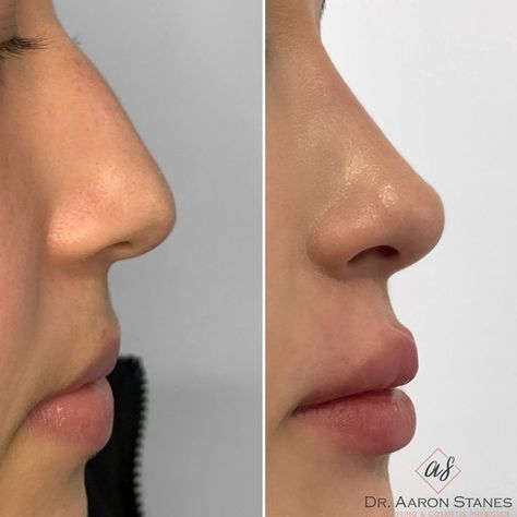 Nose Job Inspiration Straight, Nose Job Side Profile, Best Noses, Cute Nose Front View, Side Nose Profile, Nose Jobs Inspiration, Front Nose Profile, Turkish Rhinoplasty, Low Nose Bridge Side Profile