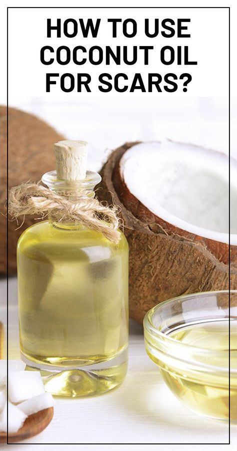 Does Coconut oil Help with Scars And How To Use It? Stretch Mark Cream Pregnancy, Makeup Acne, Acne Scar Removal Cream, Face Map, Oils For Scars, Fungal Acne, Pimple Scars, Scar Removal Cream, Homemade Beauty Recipes