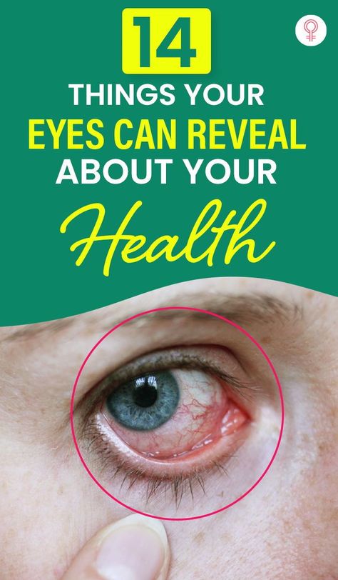 Eye Facts, Eye Twitching, Home Remedy For Cough, Eye Exercises, Cold Sores Remedies, Vision Eye, Sore Eyes, Healthy Eyes, Natural Cold Remedies