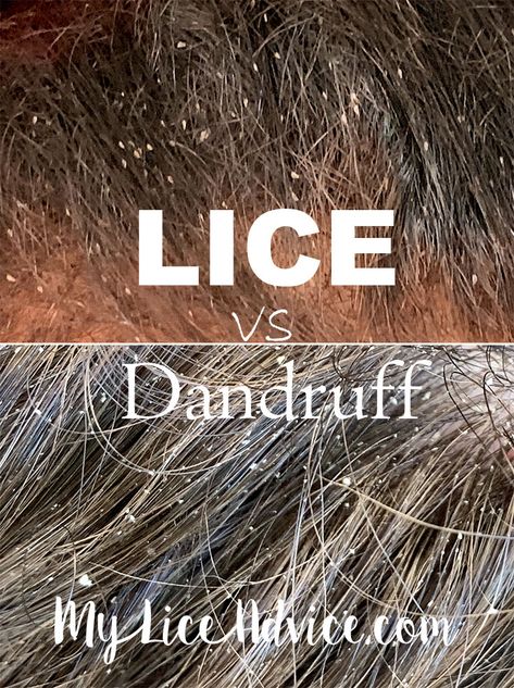 Head lice eggs (nits) and dandruff are easily mistaken for one another. This article provides side-by-side lice pictures, which will show you that the biggest difference between lice vs dandruff and other dry scalp conditions is… #lice #dandruff #liceeggs #nits #liceinhair #dryscalp Lice In Hair, Lice Pictures, Nurse Knowledge, Bug Deterrent, Lice Spray, Lice Nits, Lice Remedies, Rash On Neck, Hair Lice