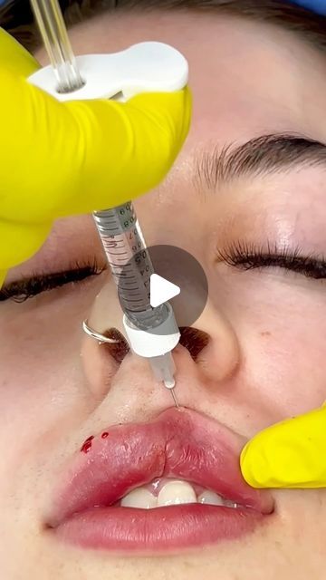 Where To Inject Lip Filler, Lip Filler Tips, Diy Lip Filler, Lip Augmentation Before And After, Lip Injections Before And After 1ml, Russian Lips Filler 1ml, Lip Injections Aesthetic, Lips Fillers Shapes, Lip Fillers 1ml