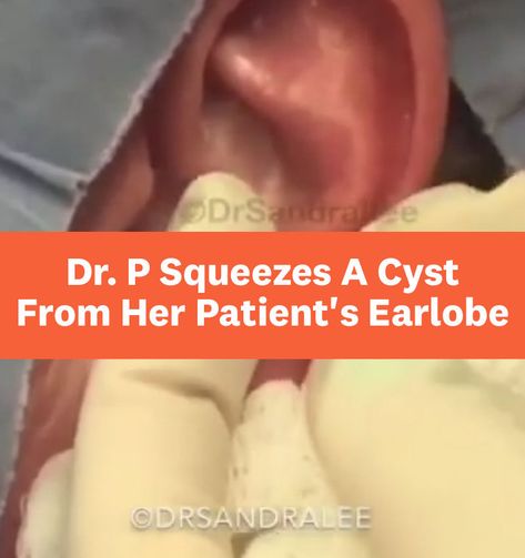 In Dr. Pimple Popper's gnarly new Instagram video, she helps a patient with a huge cyst growing on the earlobe. Ear Cysts Popping, Dr Pimple Poppìng Videos, Cysts Popping Videos, Body Acne Products, Hard Pimple, Get Rid Of Body Acne, Zit Popping Video Faces, Huge Blackheads, Big Zits