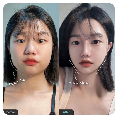 #plasticsurgery #plasticsurgerygonewrong #beforeafter #celebritiesbeforeafter #hollywoodstars #bignosesurgery #surgery #facesurgery #vlinesurgery #koreanplasticsurgery #kpopplasticsurgery #nosejob #jawreductionsurgery #eyesurgery #cheekfillers #rhinoplasty #facelift #plasticsurgeryfails #expensiveplasticsurgery #viral V Shaped Jaw, V Shaped Face, Kpop Plastic Surgery, Jaw Reduction Surgery, Change Appearance, V Line Surgery, Plastic Surgery Fail, V Line Face, Korean Plastic Surgery