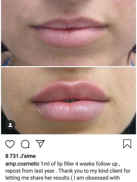 1 ml of lip filler 4 weeks follow up Different Styles Of Lip Filler, Hollywood Lips Filler, Lip Filler Shape Ideas Pouty, Lip Fillers Before And After 1ml Russian, Keyhole Pout Lips, Lip Filler Shape Ideas 1ml, Lip Filler 1 Syringe, Lips Before And After Injections, Lip Injections Shapes