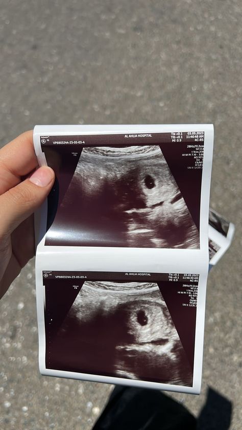 7 Weeks Pregnant Ultrasound, Ultrasound Prank, 3rd Month Pregnancy, Fake Ultrasound, Baby Ultrasound Pictures, Pregnancy Scan, Twin Baby Photos, Pregnancy Images, Fake Pregnancy