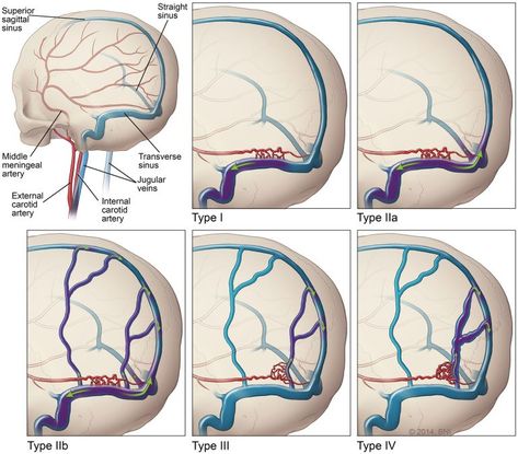 Condition Specific Radiology: Dural Arteriovenous Fistula - Stepwards Beautiful Arabian Horses, Magnetic Resonance Imaging, Ct Scan, Magnetic Resonance, Medical Illustration, Neurology, Radiology, Different Types, Brain