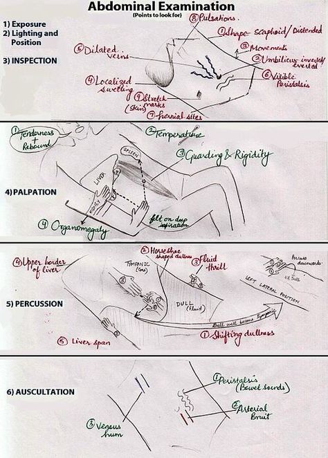 Abdominal assessment Abdominal Examination, Rovsing's Sign, Quadrants Of The Abdomen, Physician Assistant Student, Gi System, Physical Examination, Nursing Mnemonics, Medical Student Study, Nursing School Survival