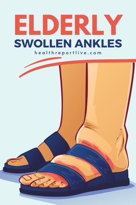 Swollen feet, vector illustration Kidney Pain, Swollen Ankles, Swollen Legs, Cold Sore, Body Pain, Lose 40 Pounds, Health And Fitness Tips, Chronic Pain, What You Can Do