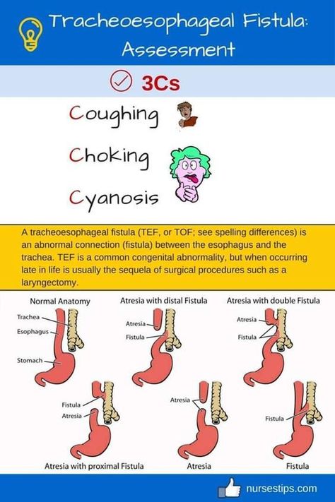 Tracheoesophageal Fistula: Assessment #nursingstudent #nursesrock #memorize - Image Credits: Jinky Perez Tracheoesophageal Fistula, Ms Nursing, Nicu Nurse Education, Pediatric Nursing Study, Medical Diseases, Nursing School Studying Cheat Sheets, Neonatal Nursing, Concept Maps, Medical Mnemonics