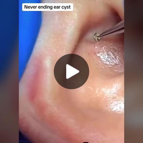 Cysts Popping Videos, S Video, Mole, Blackheads, Quick Saves