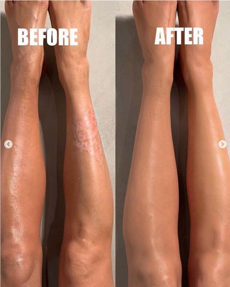 Best Body Makeup, Body Makeup For Legs Products, Leg Makeup For Veins Cover Up, Body Blur, March Photography, Tend Skin, Leg Makeup, Varicose Vein Remedy, March Book