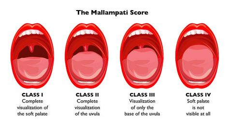 Mallampati Score Visual Image Swollen Tonsils, Home Remedies For Snoring, Soft Palate, Skin Cream Anti Aging, Snoring Remedies, How To Stop Snoring, When You Sleep, How To Get Sleep, استوديو الصور