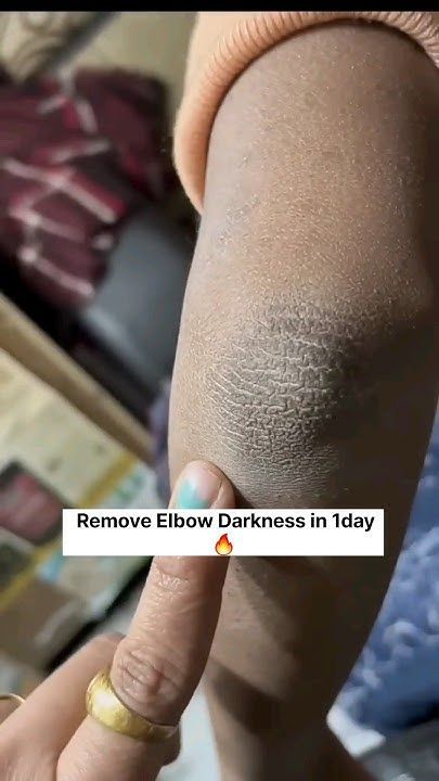 😱Get Rid of Dark Elbow/Get Fair Elbow In Just 1Day,RemoveSuntan #skincare#ytshorts#viral#viralvideo - YouTube Black Elbows Get Rid Of, How To Get Rid Of Corns On Toes, How To Get Rid Of Tanned Skin, Remove Dark Elbows, Black Neck Remedies, How To Remove Blackheads From Nose, Good Skin Tips Skincare, How To Remove Body Tan, How To Glow Skin