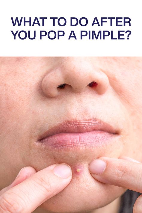 Wondering how to heal a popped pimple? Look no further, because here are some easy tips from board certified dermatologists to get rid of the acne and skin damage. How To Heal A Popped Pimple, How To Heal Popped Pimples Fast, Quickest Way To Get Rid Of Pimples, Pimple Patches Before And After, How To Get Rid Of A Pimple Instantly, Acne Popping, Pimple Solution, Pimples On Forehead, Skincare Content