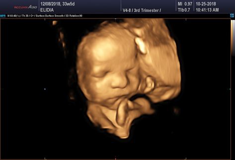 ultasound baby pictures in video.  Located in Sandy Utah, Fetal Studio can give you some amazing looks at your unborn baby.  4d images are much better than 3d.  Come see for yourslelf. 4d Ultrasound Pictures, 3d Ultrasound Pictures, Sandy Utah, 4d Ultrasound, Sound Picture, Ultrasound Pictures, Unborn Baby, Ultrasound, Baby Pictures