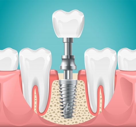 Free Dental Implants, Tooth Implant, Affordable Dental Implants, Dental Images, Dental Implant Procedure, Dental Posters, Best Dental Implants, Bone Grafting, Dental Implant Surgery