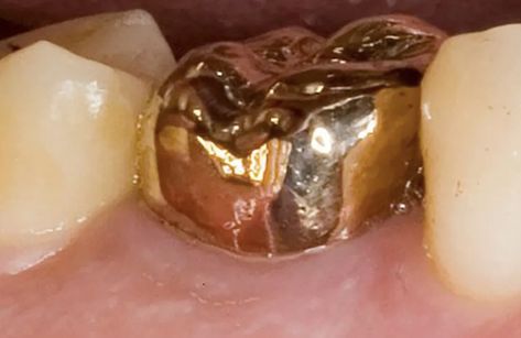 At one time, gold #dentalCrowns were all the rage. Nowadays, most people prefer the natural look you get from #allPorcelainCrowns. Here’s how the two stack up against each other. #BestDentistSurreyBC Permanent Gold Teeth, Tooth Crown, Gold Tooth, Tooth Repair, Dental Emergency, Restorative Dentistry, Emergency Dentist, Dental Veneers, Dental Cleaning