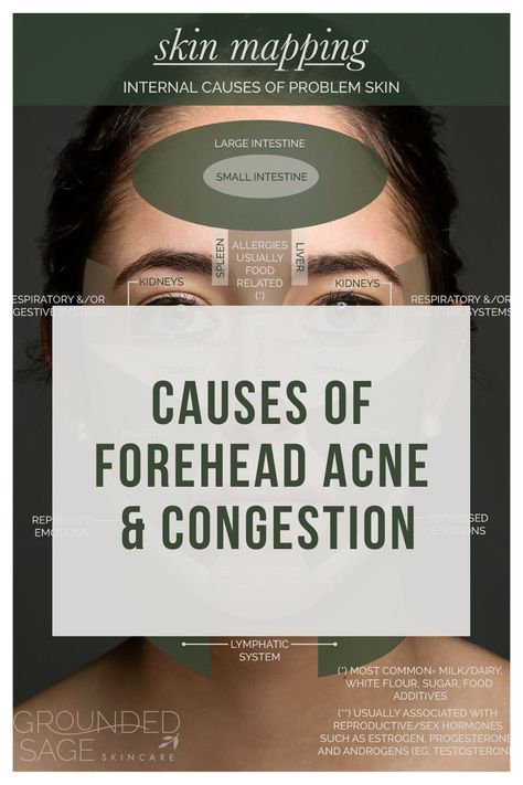 Forehead Acne Cause, Skin Care Routine Tips, Forehead Bumps, Skin Mapping, Pimples On Forehead, Face Mapping Acne, Forehead Acne, Natural Acne Remedies, Acne Skincare Routine