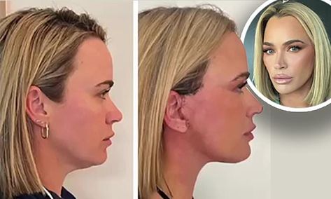 Teddi Mellencamp, 40, shares before and after photos of her neck lift Teddy Mellencamp, Neck Lift Before And After, Lower Face Lift, Teddi Mellencamp, Chiseled Jaw, Shoulder Length Blonde, Face Lift Surgery, Neck Lift, Kyle Richards