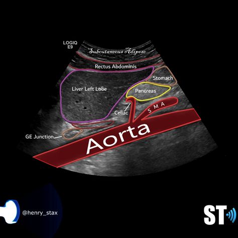 Aorta Duplex/Doppler Protocol – Sonographic Tendencies Diagnostic Medical Sonography Student, Ultrasound School, Ultrasound Physics, Liver Anatomy, Cardiac Sonography, Sonography Student, Vascular Ultrasound, Ultrasound Sonography, Abdominal Aorta