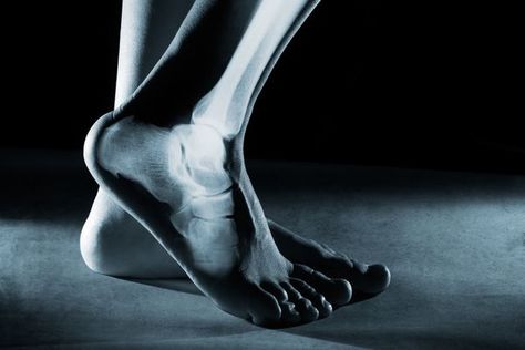 So, You've Injured Your Ankle. Here Are 3 Signs You Should Get It Checked Facitis Plantar, Hairline Fracture, Bone Fracture, Cheer Shoes, Ankle Pain, Nerve Damage, Bone Density, Foot Pain, Shoe Laces