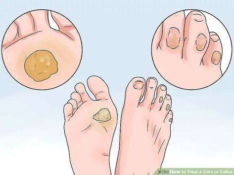 How to Treat a Corn or Callus (with Pictures) - wikiHow Callus Remover Diy, Get Rid Of Corns, Corn Removal, How To Make Corn, Nail Problems, Corn Seed, Skin Tags, Cracked Heels, Callus Removal