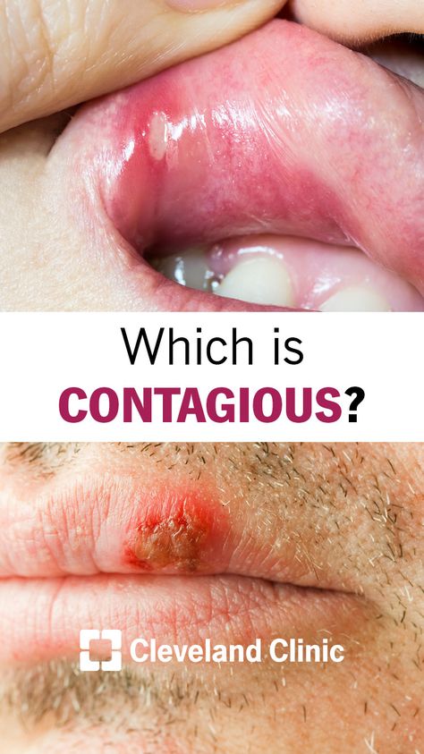 What's the difference between canker and cold sores?  #health #oralhealth Fever Blister, Tooth Decay Remedies, Cold Sores, Canker Sore, Social Well Being, Tongue Health, Gum Care, Cleveland Clinic, Cold Sore