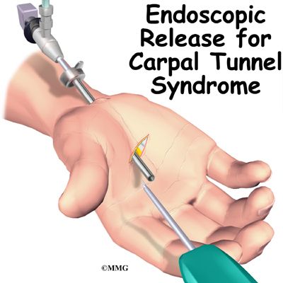 Carpal Tunnel Syndrome - eOrthopod.com Carpal Tunnel Surgery Recovery, Carpal Tunnel Exercises, Carpal Tunnel Surgery, Carpal Tunnel Relief, Median Nerve, Nerve Health, Muscle Atrophy, Health Disease, Wrist Pain