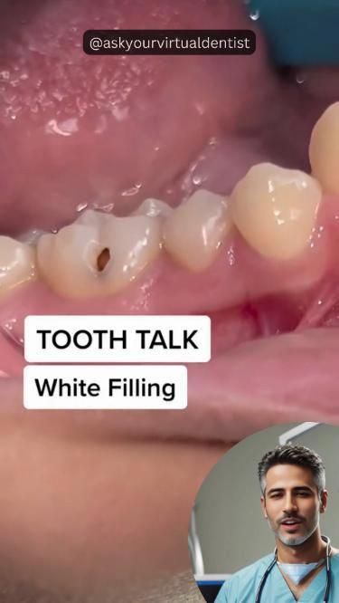 Teeth Bonding, Composite Fillings, Dental Decay, Dental Videos, Dental Fillings, Dental School, How To Prevent Cavities, Oral Care Routine, Gum Care