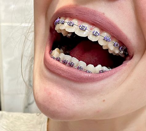 Purple colour has several benefits when it comes on braces. Teeth seem whiter and stainless. Aesthetic Teeth, Dental Braces Colors, Braces Colors Combinations, Pink Braces, Kawat Gigi, Braces Bands, Cute Braces Colors, Braces Cost, Pretty Teeth