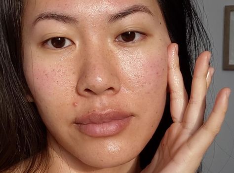 Find out what causes acne scars to be red and how to get red rid of red acne scars. Plus! FREE EXPRESS SHIPPING & AFTERPAY available on our 250+ beauty brands, including vegan products. What Causes Acne, Red Acne Marks, Marks On Face, Acne Redness, Anti Redness, Get Rid Of Acne, Severe Acne, Rid Of Acne, Vegan Products