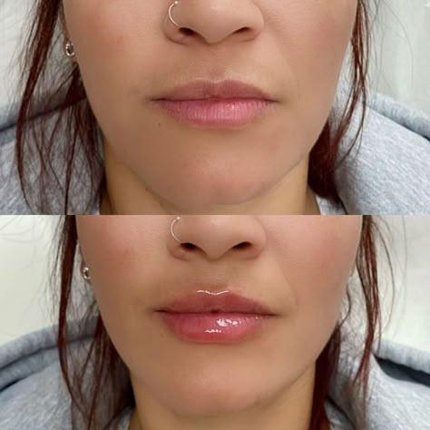 Nurse Marianne on Instagram: "Mini lip plump for my beautiful client 🪄 💋 👩🏽‍⚕️ Procedure: Non-surgical lip augmentation 🗓 Duration: 6-12 Months on average 💰 Cost: $449-$549 a syringe ⏱ Recovery: Immediate redness, bruising and/or swelling can be present after injections and will subside over the next few hours to days but can take up to 4 weeks to fully heal and settle in Afercare: 🧊 Apply ice to reduce swelling 🏋🏽‍♀️Avoid strenuous exercise for 24 hours 🥂 Avoid alcohol for 24-48 hours Key Hole Lips Injections, Full Syringe Lip Filler, Light Lip Injections, Mini Lip Plump Before And After, Lip Augmentation Before And After, Mini Lip Filler, Lip Injections Before And After 1ml, Half Syringe Lip Filler, Half Syringe Lip Filler Before And After