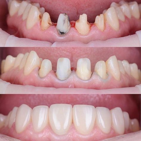 DENTISTRY SCIENCE on Instagram‎: "Build up - 3M Fiber Post+Bulk Fill. Ceramic crowns e.max. . By @stomatolog_31 . . . * ・・・ #dxb #dubai #dental_clinic #cosmeticdentistry #dentoart_worldwide #dentalphotography #luxury #esthetician #compositeveneers #hollywoodsmile #cosmeticdentistry #veneers #directcomposite #dentalart #dentistryworld #dentistrylove #dentaloffice #dentistica #dentalphotography #dentaltechnician #dentalhygienist #dentisteylife #composite #compositeveneers ‏#smiledesign #c Luxury Esthetician, Dental Crown Procedure, Dental Ceramics, Esthetic Dentistry, Dental Posts, Dental Aesthetics, Dental Photography, Dental Implants Cost, Dental Anatomy