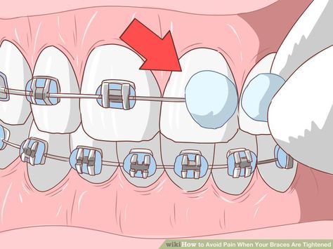 Foods To Eat With Braces Soft, Soft Foods To Eat After Getting Braces, How To Eat With Braces, Foods For Braces Soft, Food For Braces For Kids, Soft Food After Braces, Food With Braces, Braces Friendly Food, Food To Eat With Braces