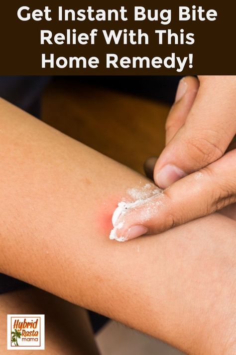 Stop Bug Bites From Itching, How To Treat A Bee Sting, Diy Bug Bite Itch Relief, Bee Stings Relief Swelling, Bee Sting Remedies, Bee Sting Swelling, Bug Bite Swelling, Bee Sting Remedy, Bee Sting Relief